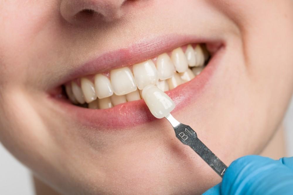 7 Problems That Veneers Resolve
