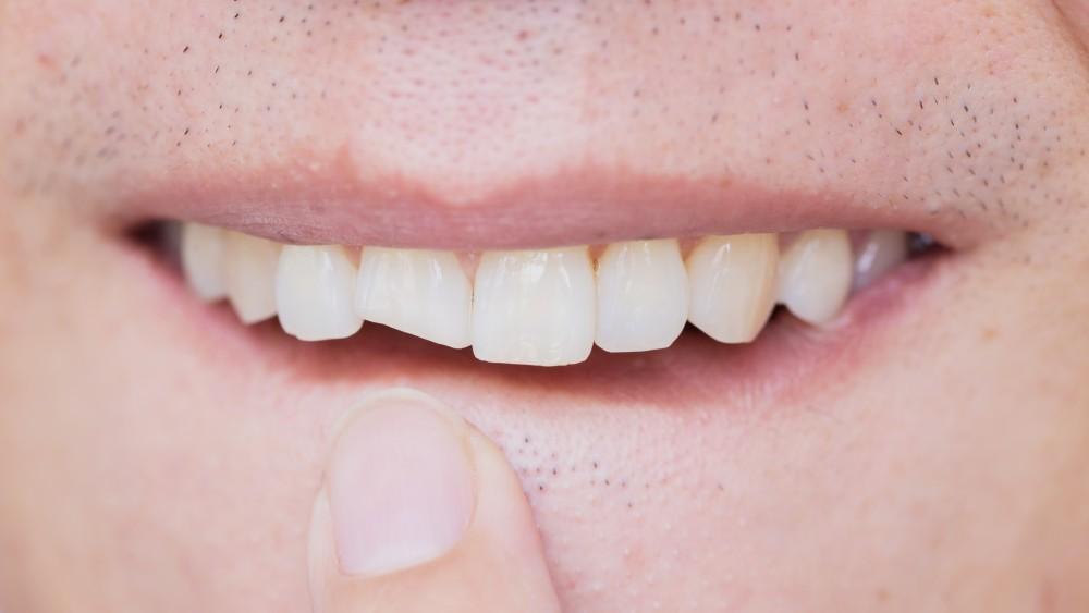 Can Veneers Help My Chipped Teeth?