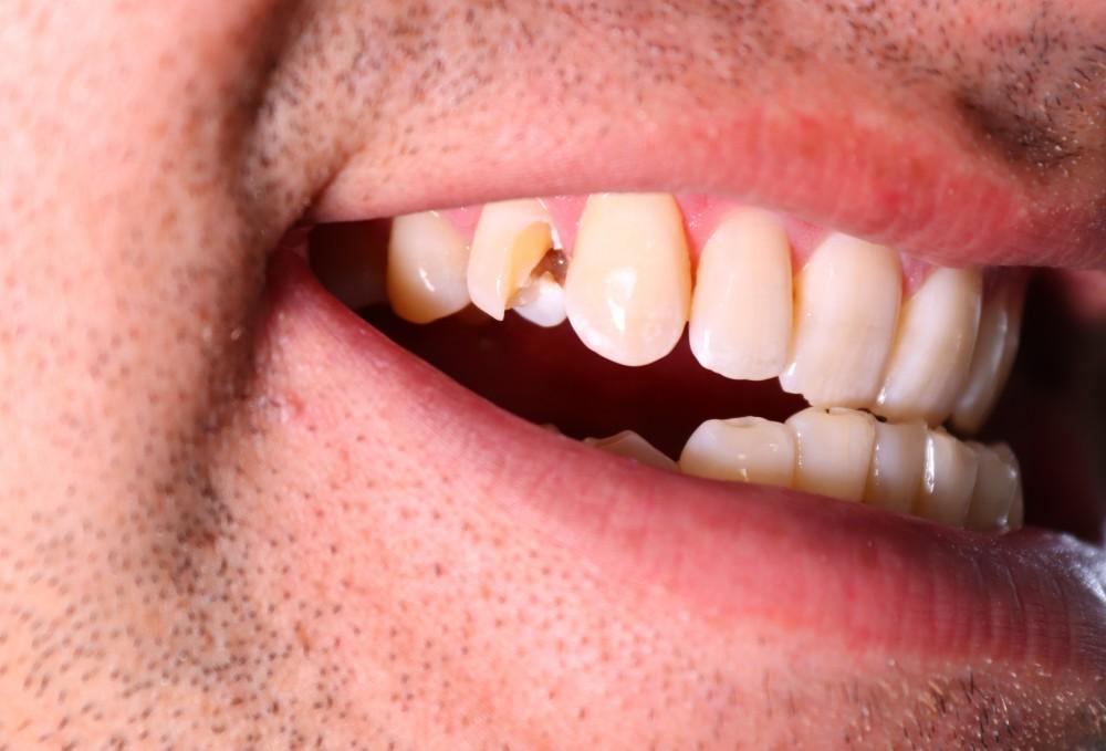 Is It Bad to Have Gapped Teeth?